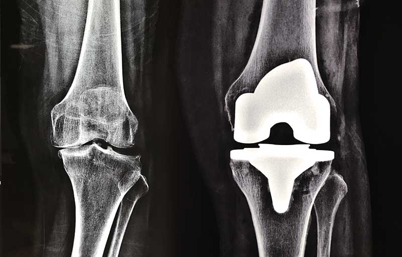 Operasi Penggantian Sendi Lutut