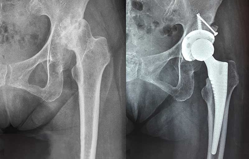 Operasi Penggantian Sendi Panggul