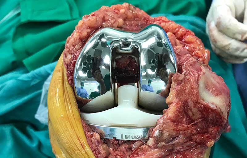 Operasi Penggantian Sendi Lutut