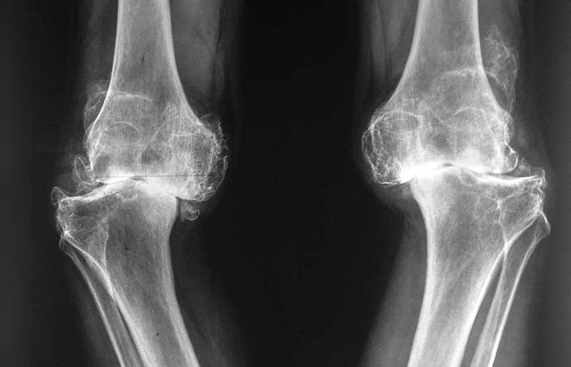 Operasi Penggantian Sendi Lutut