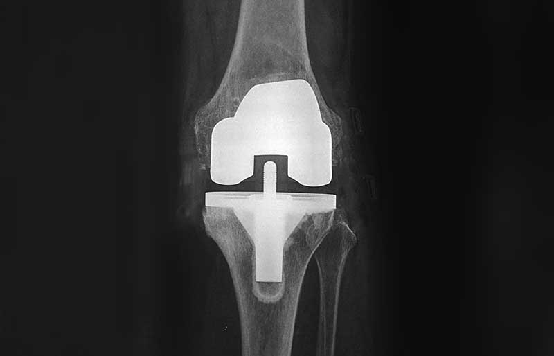 Operasi Penggantian Sendi Lutut