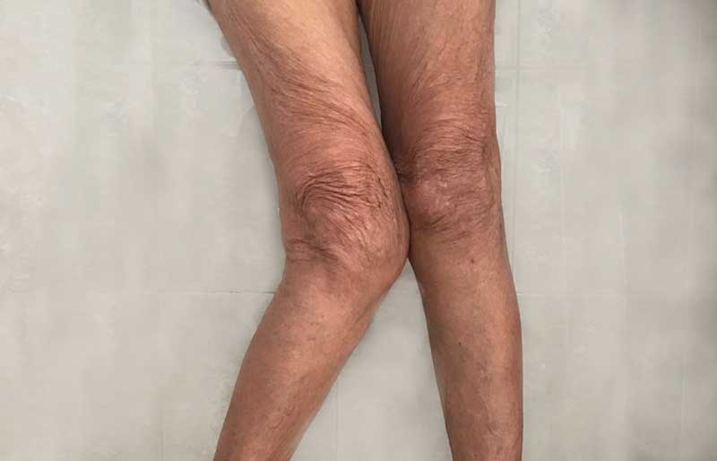 Operasi Penggantian Sendi Lutut