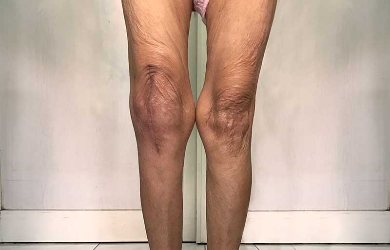 Operasi Penggantian Sendi Lutut