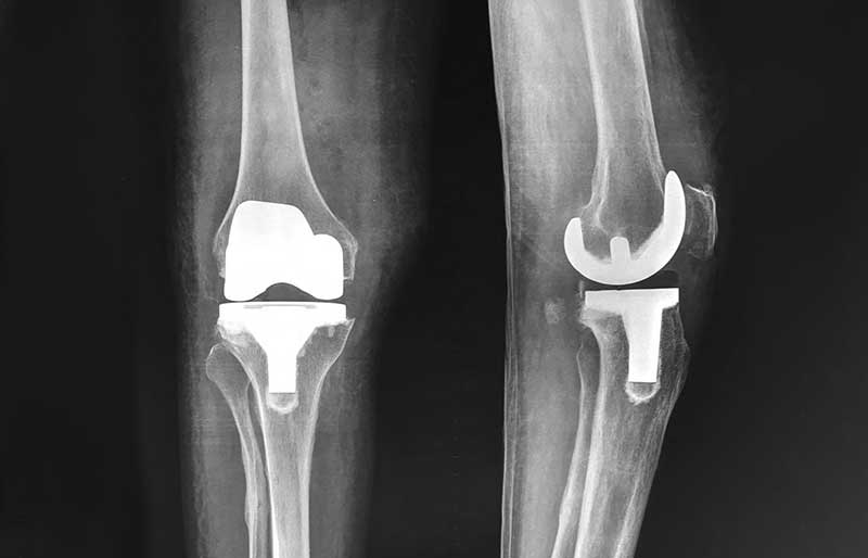 Operasi Penggantian Sendi Lutut