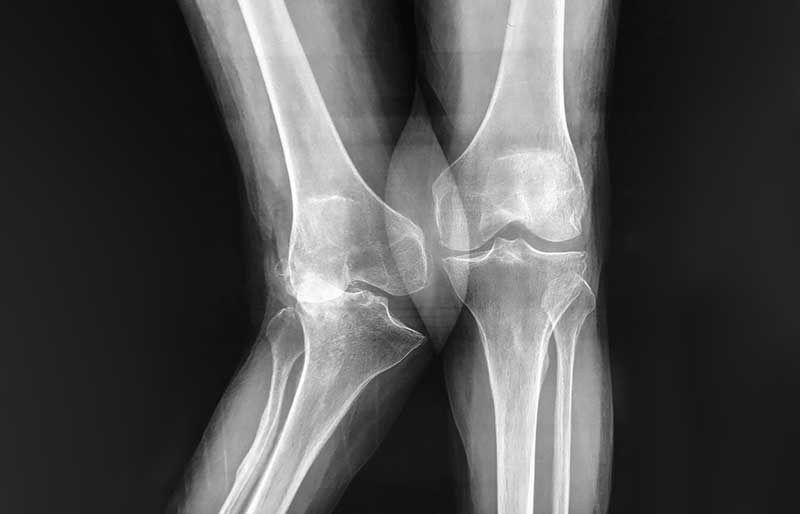 Operasi Penggantian Sendi Lutut