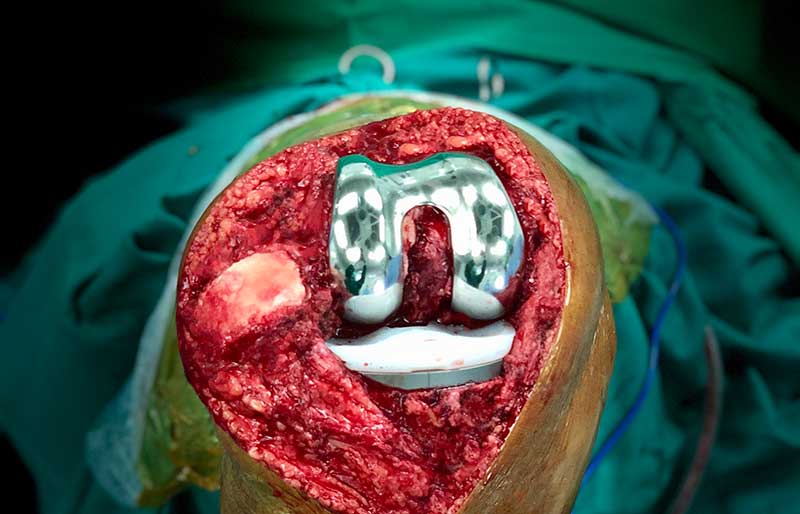 Operasi Penggantian Sendi Lutut