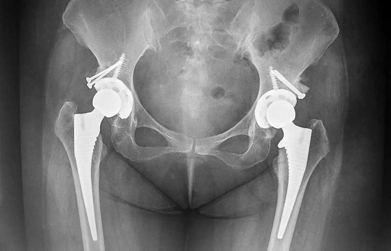 Operasi Penggantian Sendi Panggul