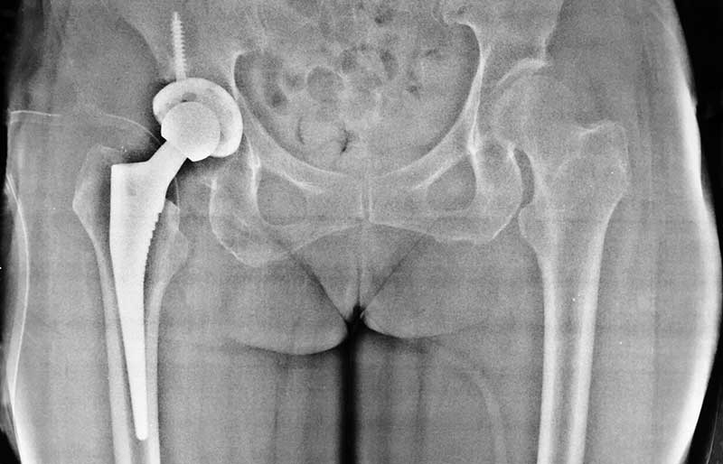 Operasi Penggantian Sendi Panggul