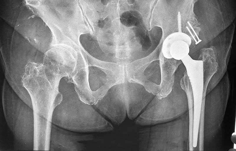 Operasi Penggantian Sendi Panggul
