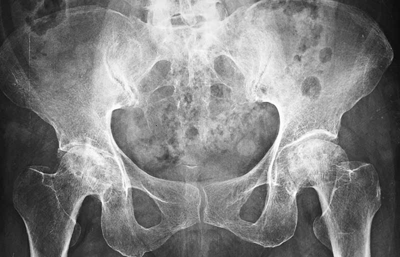 Operasi Penggantian Sendi Panggul