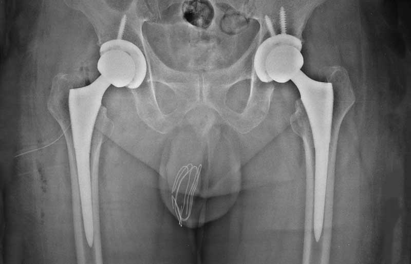 Operasi Penggantian Sendi Panggul