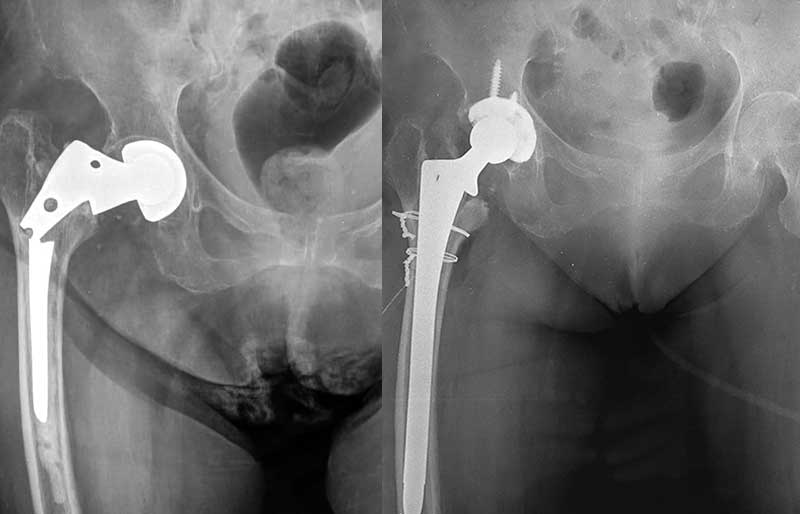 Operasi Penggantian Sendi Panggul